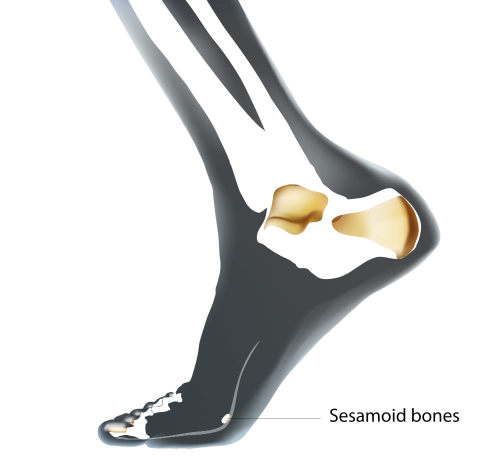 Sesamoiditis Brighton Road Podiatry