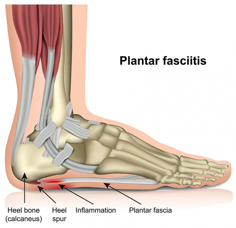 plantar fasciitis illustration